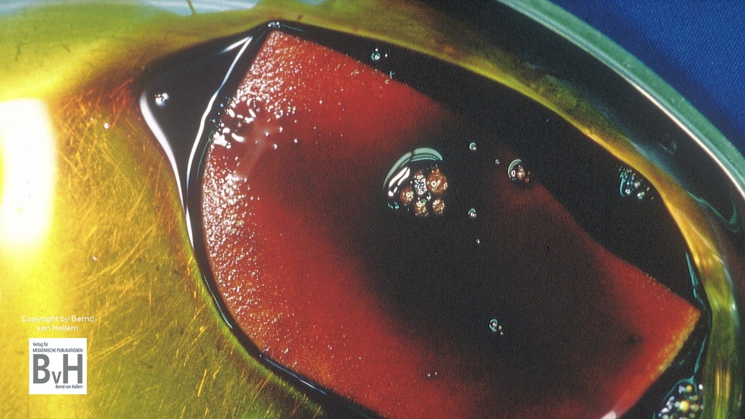 1Ein Cavity Schaum wurde in einer Nierenschale mit PVP Iod getränkt