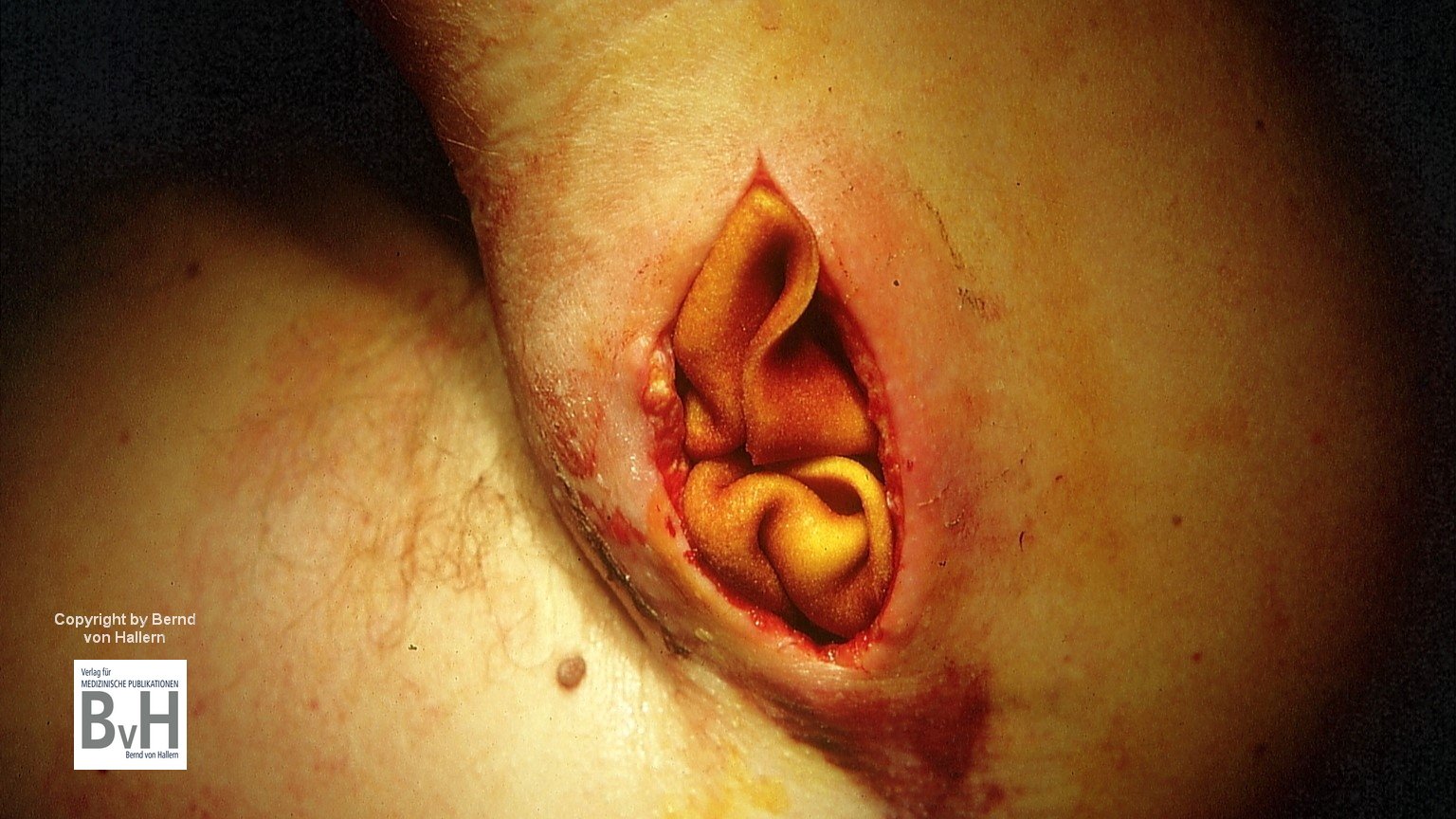 Nach Abszessspaltung am Oberarm wurde ein PVP Iod getränktes Cavity