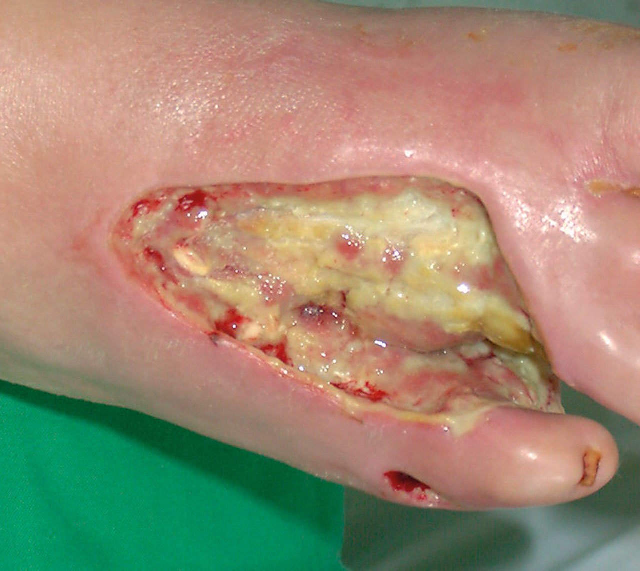 Biochirurgie Bild li Ulzerationen am Unterschenkel vor Larventherapie