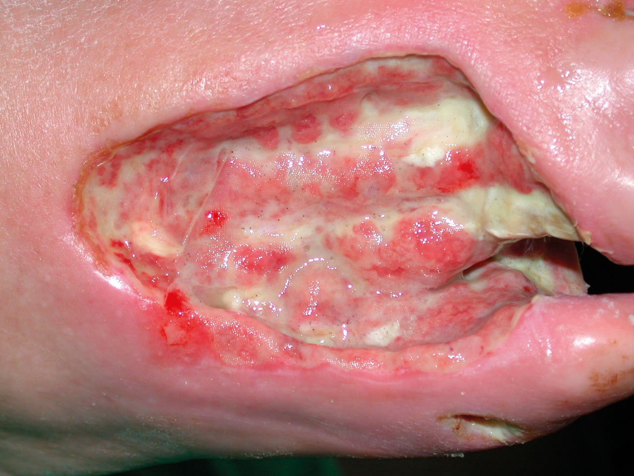 Biochirurgie Bild re Die selbe Wunde nach 4 Tagen Larventherapie